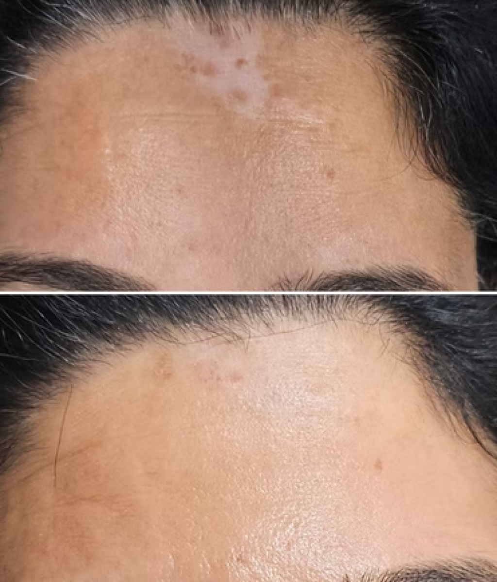 Medical Tattooing performed on accident scar on forehead